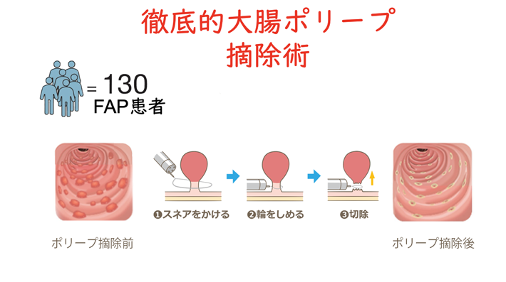 図2 FAP患者さんに対する徹底的大腸ポリープ摘除術 